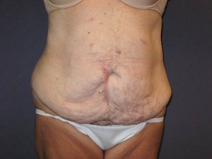 Before - anterior