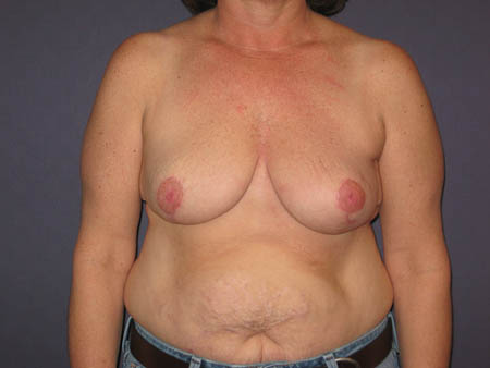 Left lumpectomy reconstruction , Right Reduction - post view.