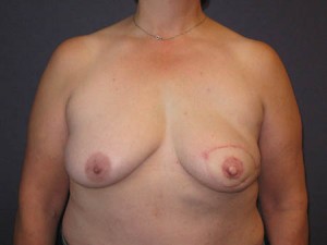 Post tailoring and nipple reconstruction
