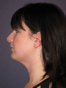 Post op lateral view