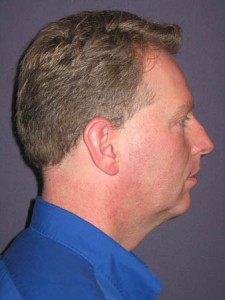 Lateral before