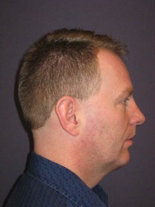 Lateral after
