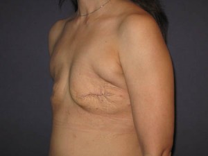 Pre oblique view