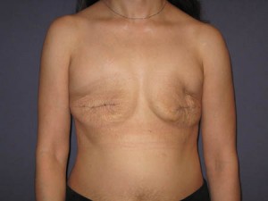 Pre anterior view