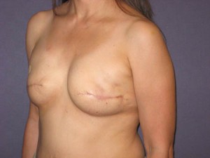 Post expansion / Pre fat grafting