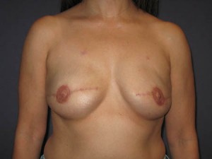 Post implant exchange, nipple reconstruction, and fat grafting anterior view