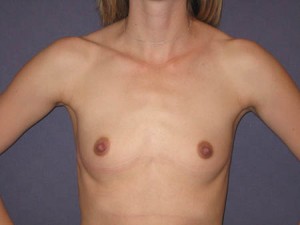 AP pre op
