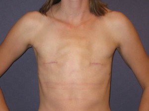 AP post mastectomy