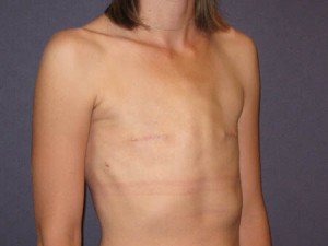 Oblique post mastectomy