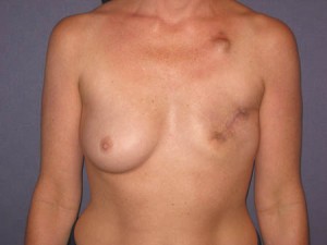Pre Op