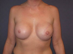 Post Op