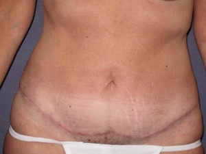 Post Op