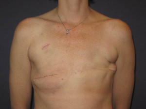 Post right tissue sparing mastectomy