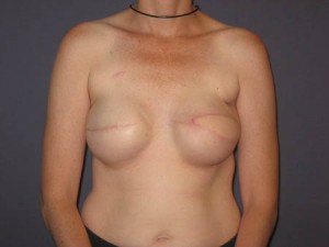 Post bilateral expander and left latissimus flap