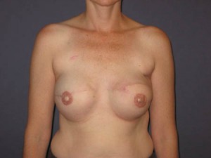 Post implant exchange and nipple areolar reconstruction