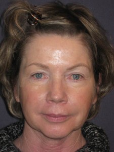 Before Juvederm filler injection