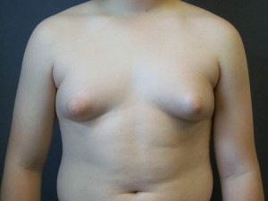 Gynecomastia AP view