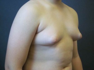 Gynecomastia Oblique view