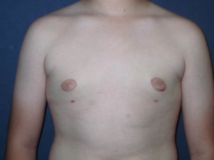 Gynecomastia post op