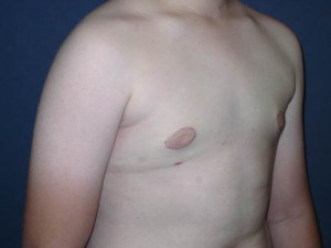 Gynecomastia post op