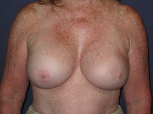 post op