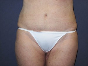 Anterior Pre op