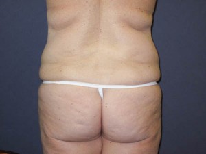 Posterior Pre op