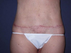 Anterior Post op