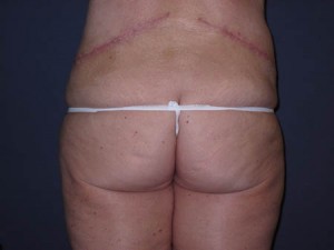 Posterior Post op