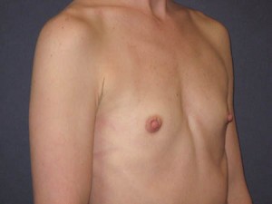 Pre op oblique view