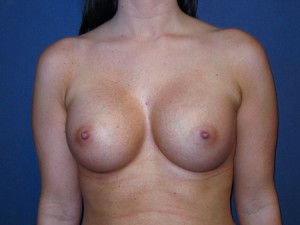 Post anterior view