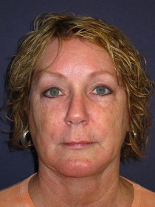 anterior post op