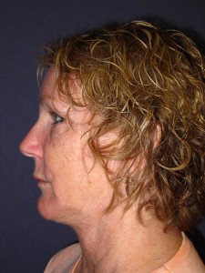 lateral post op