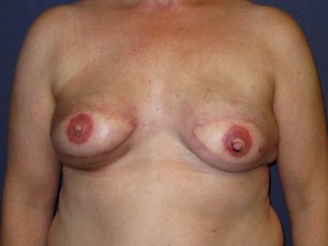 after implant exchange