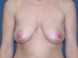 pre mastopexy