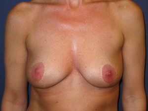 post mastopexy - late result