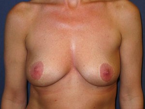 post mastopexy - late result
