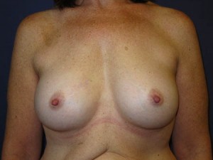 Post op