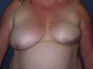 Pre Op