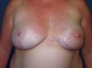 Post Op