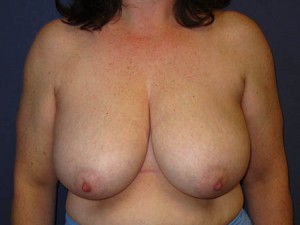 Pre op