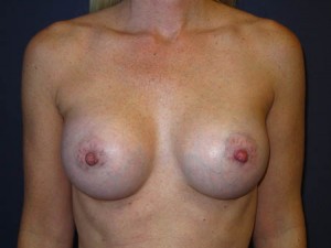 Post Op