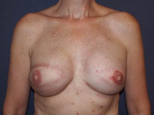 Post implant exchange and nipple reconstruction
