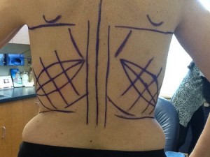 Markings for latissimus flaps