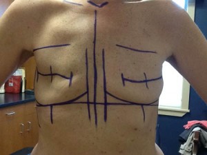 Post mastectomy