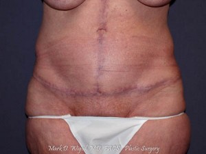 Post op