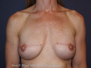 Post Op anterior