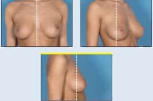 breast guide 300x199 1