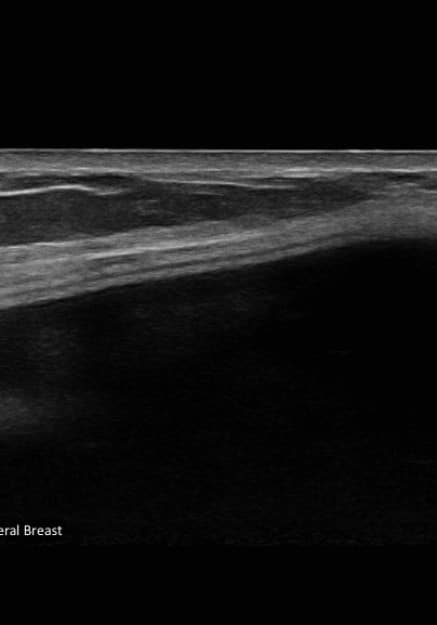 After Image: Ultrasound Smooth versus Textured Implant - front