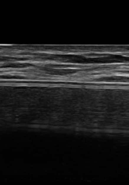 Before Image: Ultrasound Smooth versus Textured Implant - front